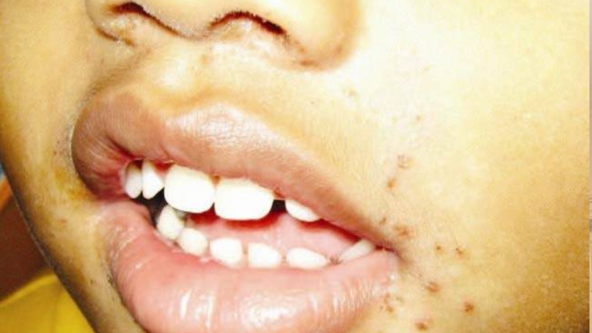 4 Suspected Cases Of Hand, Foot And Mouth Disease At Primary School in Clarendon – YARDHYPE