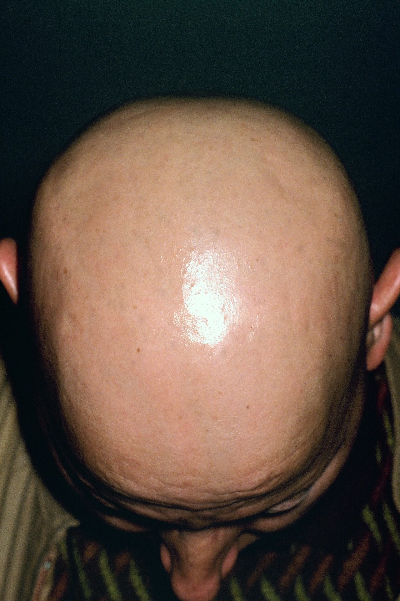 New Alopecia Treatment Drug Approved By The FDA