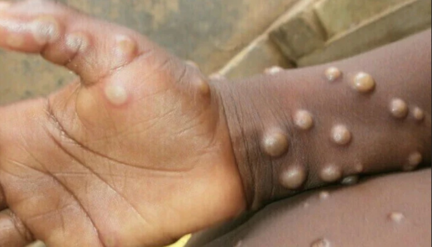 Second Monkeypox Case Confirmed In Jamaica – YARDHYPE