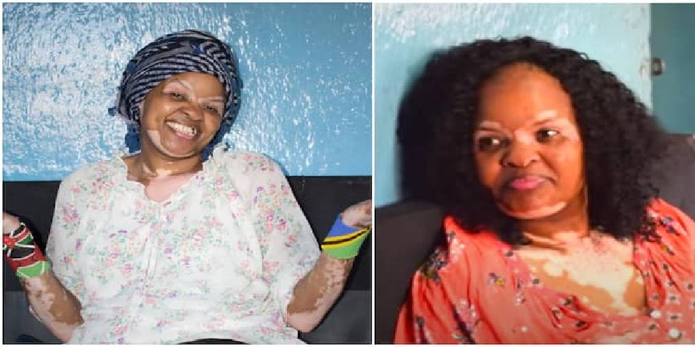 Ex -Machachari Actress Mama Stella Says Says She Is Not Getting Acting Jobs Due to Her Vitiligo